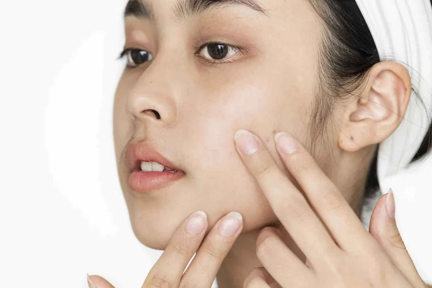 acne treatment Dubai