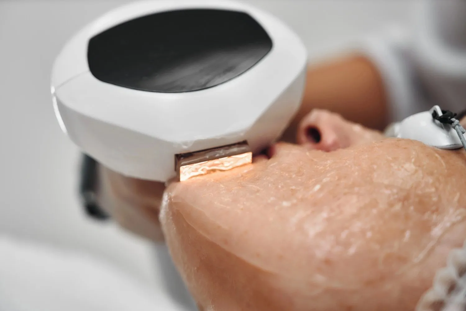 laser hair removal near me