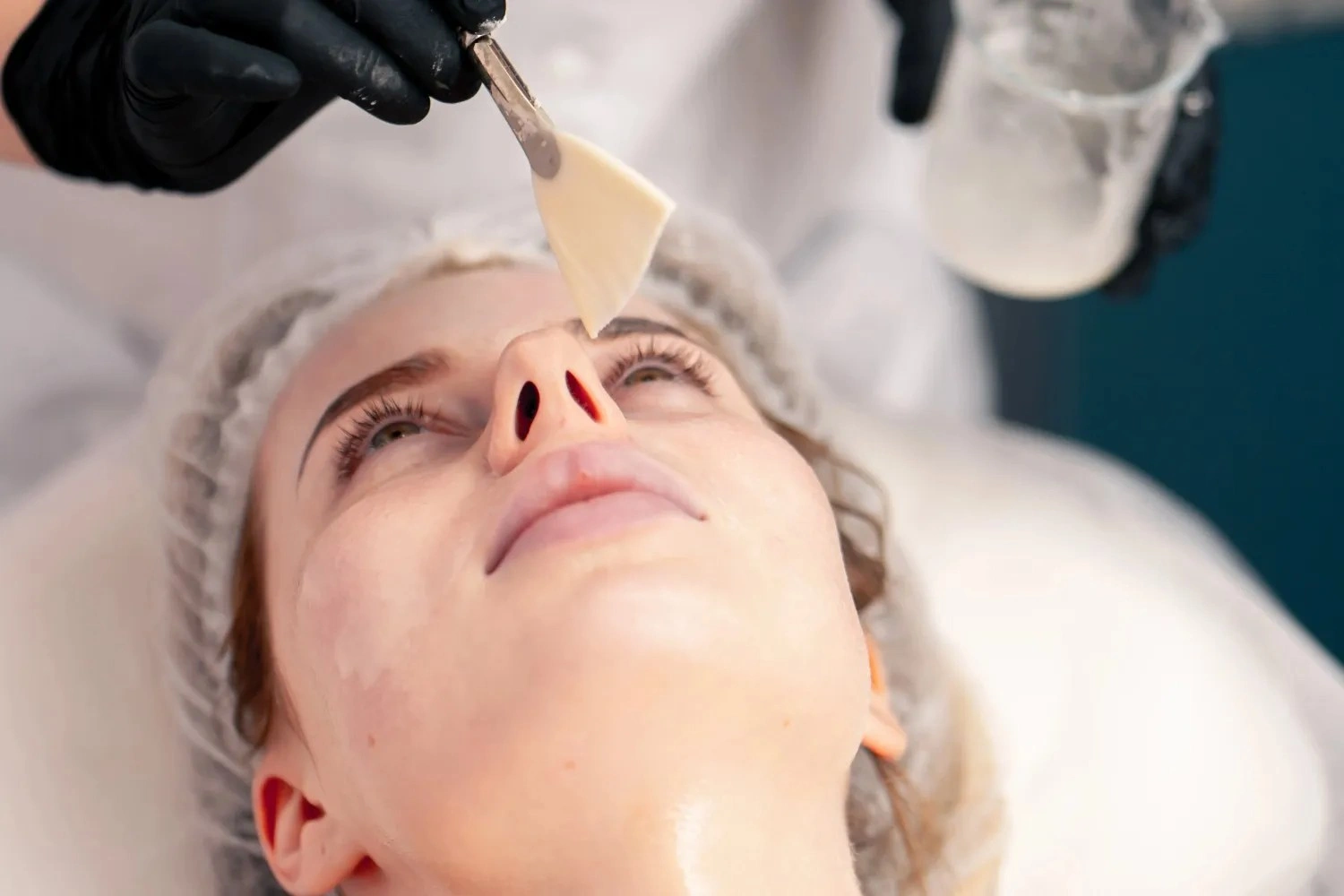 skin peel Dubai